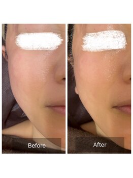 ラビ(RABBI)/50代女性　小顔矯正