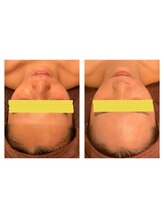 エスプリ 銀座店/ハーブピーリング銀座