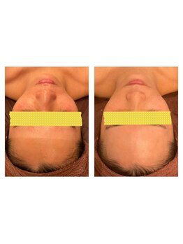 エスプリ 銀座店/ハーブピーリング銀座