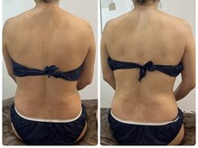 ピンクマジック(PINKMAGIC)/リリースカッター施術ビフォアフ