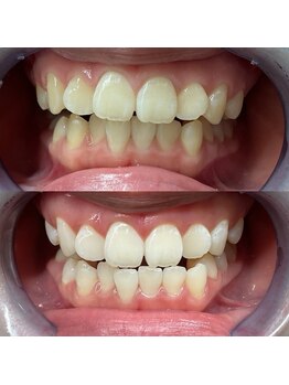 ホワイトニングセンター 大阪羽曳野店/最近乃歯科ホワイトニングお客様