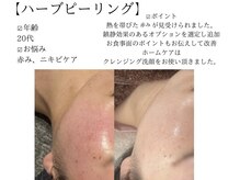 サロンツキ(salon tuki)/ハーブピーリング症例/徳島