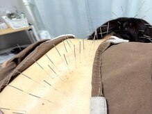 大人気!!ナノミストサウナと鍼灸施術のセットで相乗効果◎ 