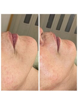 エードット(A.)/ソフトダーマ