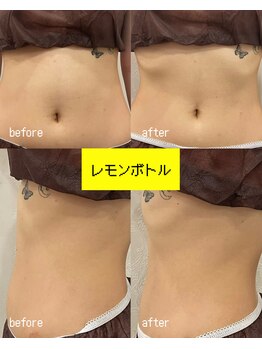 ヘルディン(heldin +555)の写真/【 レモンボトル 】韓国発祥・人気の脂肪分解☆