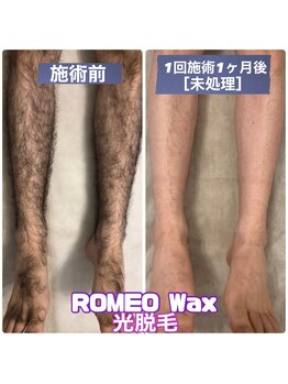 ロミオワックス ジュリエットワックス 新宿店(ROMEO Wax Juliet Wax)/光脱毛経過写真☆メンズ脱毛