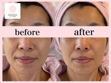 サクラ(SAKURA)/口周りがスッキリすると若々しく