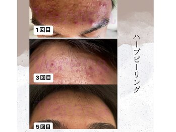 ベルーテ 田町三田(Bellute)/生まれ変わる新しい肌へ★