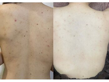 ラビエス(LAVIES)/20代背中の痒みにハーブエステ