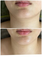 ビジュープラス 幸手店(Bijou+)/美白・シミケア