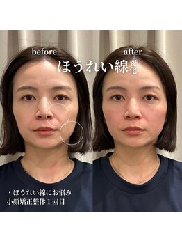 フェアリーフェイス 南森町店(Fairy Face)/南森町/小顔矯正１回目
