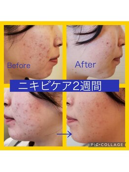 ボーテ(beaute)/【ニキビケア】