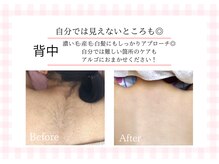 アルゴ 熊本宇土店(ALGO)/【背中】脱毛10回目で効果絶大◎