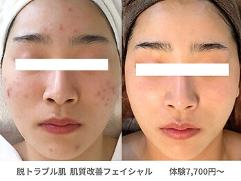 ピュアノア 三木店/水光毛穴ピーリングフェイシャル