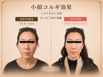 STBエステサロンの写真/小顔コルギ×ヘッド×モデリングパックで速攻小顔へ。

韓国国家美容・肌管理免許保有オーナーが担当！
