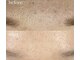 シーズン 岡崎の写真/【毛穴の黒ずみ・汚れを解消】気になる毛穴汚れもワックスでスッキリつるんとなめらか素肌美人◎