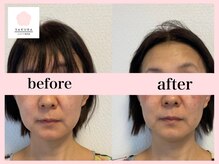 サクラ(SAKURA)/50代◎1回でも変化します。