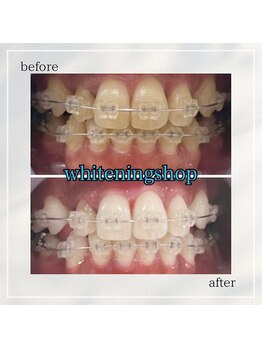 ホワイトニングショップ 岡山問屋町店/お客様のbefore&after