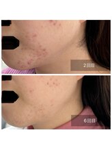 ミドリ(MIDORI)/繰り返すニキビ徹底ケア症例5