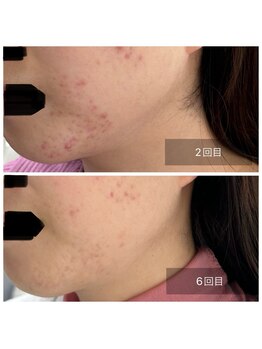 ミドリ(MIDORI)/繰り返すニキビ徹底ケア症例5