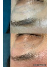 エンユイ 横浜 元町(EnnYui)/美容電気脱毛モニター男女60分♪