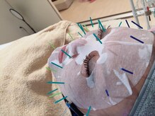 瑞 鍼灸院/幹細胞美容鍼