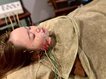 リラ鍼灸接骨院(Rela鍼灸接骨院)/美容しんきゅう