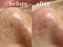 ラティエル(Latiele)/毛穴エクストラクション