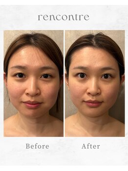 ランコント(rencontre)/毛穴/ヘッドスパ/小顔/リンパ