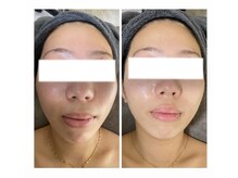 エヌ(enu)/ハーブピーリング/フェイシャル