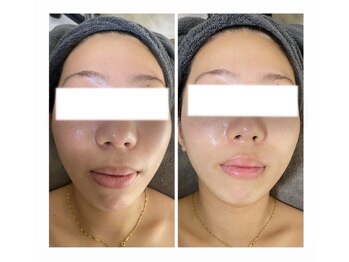 エヌ(enu)/ハーブピーリング/フェイシャル