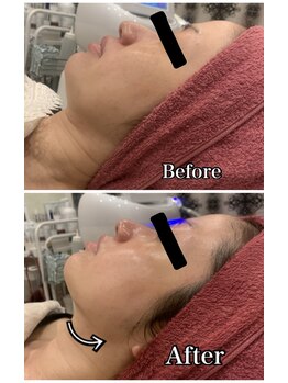 ブランシュール/小顔タイト×ヒト幹細胞導入