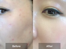 ミルジュ(MiLuJu)/ニキビでお悩みの方へ