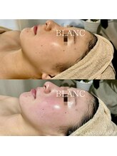 サロン ド ブラン アオヤマ(Salon de BLANC AOYAMA)/ビオフィート×ソノケア