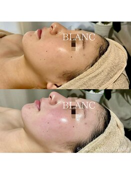 サロン ド ブラン アオヤマ(Salon de BLANC AOYAMA)/ビオフィート×ソノケア