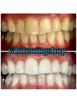 ホワイトニングショップ 吉祥寺2号店/ お写真全て加工無し!