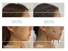 ベール(BEHL)/コルギのBefore After