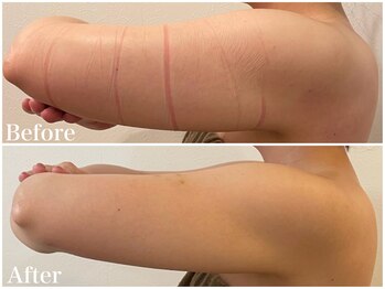 サロンドフェイス(Salon de Faith)/【ブライダル】2回施術♪