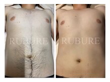 ルブレ Ginza5店(RUBURE)/【お腹脱毛ビフォアフター】