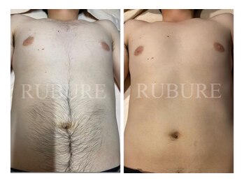 ルブレ Ginza5店(RUBURE)/【お腹脱毛ビフォアフター】