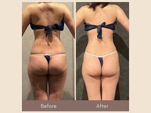 エクラ(ECLAT)/コアヒート痩身