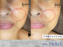 めいてる/ツヤ肌フェイシャルエステ１回