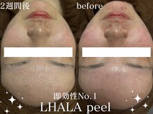 グランクウォーレ(Gran Cuore)/ララピールでニキビケア◎