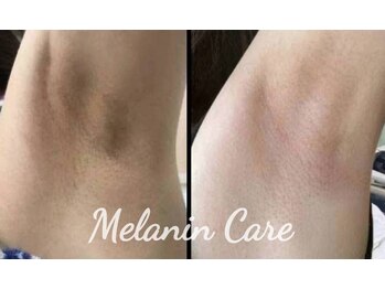 ペキュリア 恵比寿店(PEQLIA)/最新の黒ずみケアで脇ケア♪