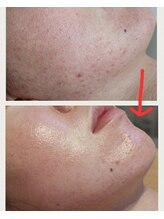 ベビースキン(baby skin)/ニキビ肌改善