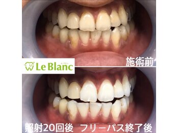 ルブラン 奈良店(Le Blanc)/照射回数重ねて