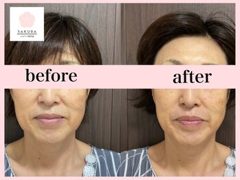 サクラ(SAKURA)/50代口周りのハリ弾力UP　1回
