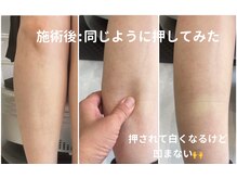 フルール エンビロン(フルール ENVIRON)/足のむくみ　2　施術終了後