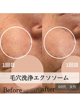 パルティノ 高崎店/毛穴洗浄エクソソーム