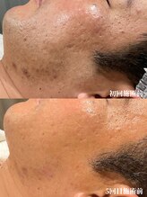 ゼアー(THERE FY.)&nbsp;メンズフェ イシャル